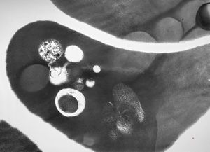 M,49y. | blood - dyserythropoetic anemia M,49y. | blood - dyserythropoetic anemia
